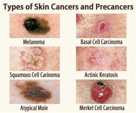 SkinCantor .
